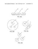 METHODS AND DEVICES FOR TREATING MIGRAINES WITH ELECTROMAGNETIC     STIMULATION diagram and image