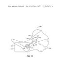 METHODS AND DEVICES FOR TREATING MIGRAINES WITH ELECTROMAGNETIC     STIMULATION diagram and image