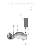 METHODS AND DEVICES FOR TREATING MIGRAINES WITH ELECTROMAGNETIC     STIMULATION diagram and image