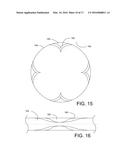 Inlays for Surface Indicia diagram and image