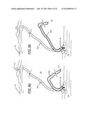 FLUID COLLECTION RESERVOIR AND ANTI-SPILL MECHANISM diagram and image