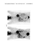 Detection of Early-Stage Pancreatic Adenocarcinoma diagram and image