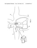 IMPLANTABLE DIELECTROMETER diagram and image