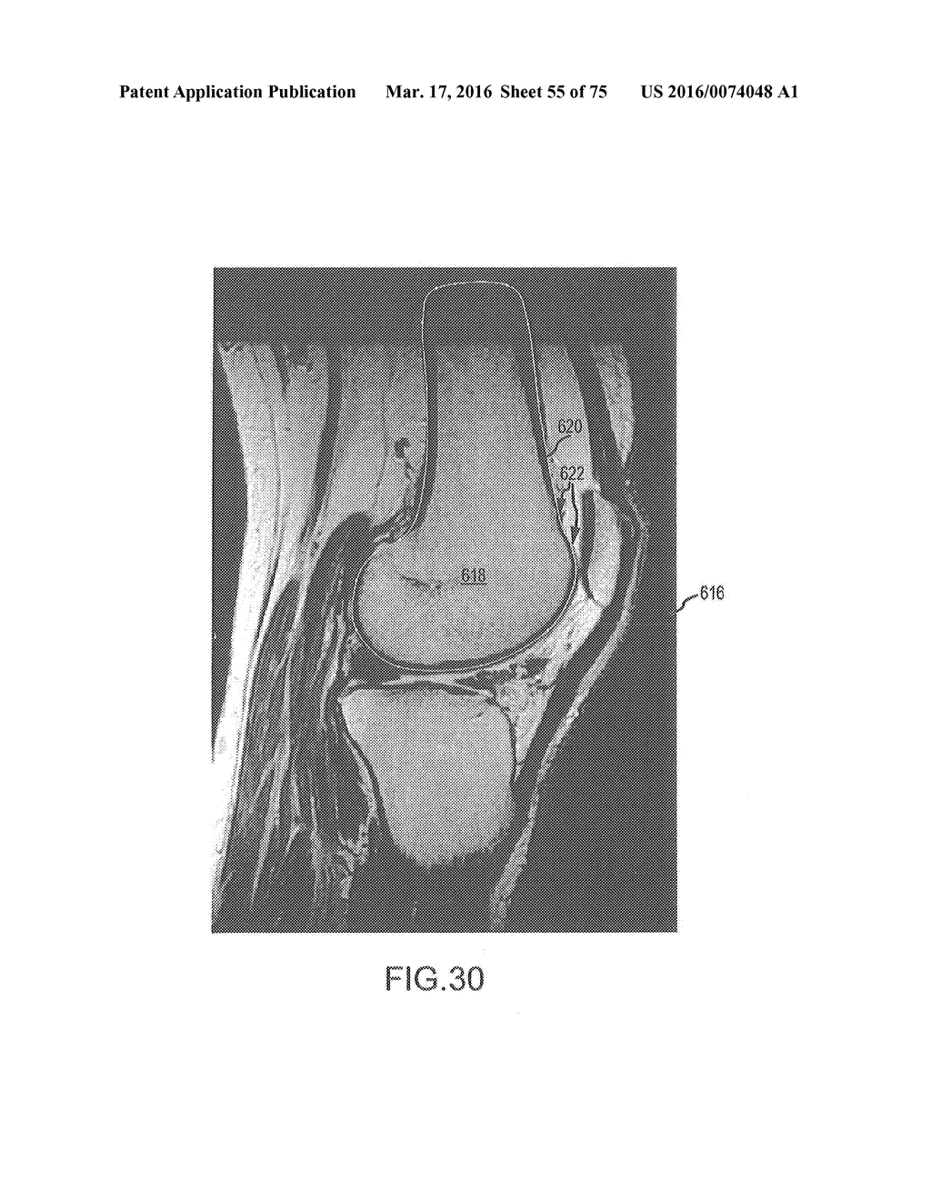 SYSTEM AND METHOD FOR IMAGE SEGMENTATION IN GENERATING COMPUTER MODELS OF     A JOINT TO UNDERGO ARTHROPLASTY - diagram, schematic, and image 56