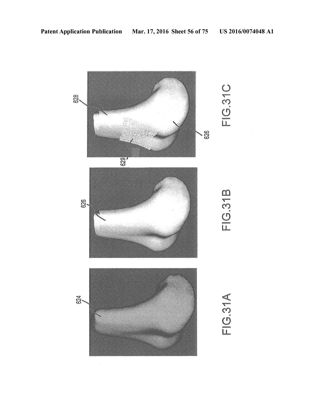 SYSTEM AND METHOD FOR IMAGE SEGMENTATION IN GENERATING COMPUTER MODELS OF     A JOINT TO UNDERGO ARTHROPLASTY - diagram, schematic, and image 57