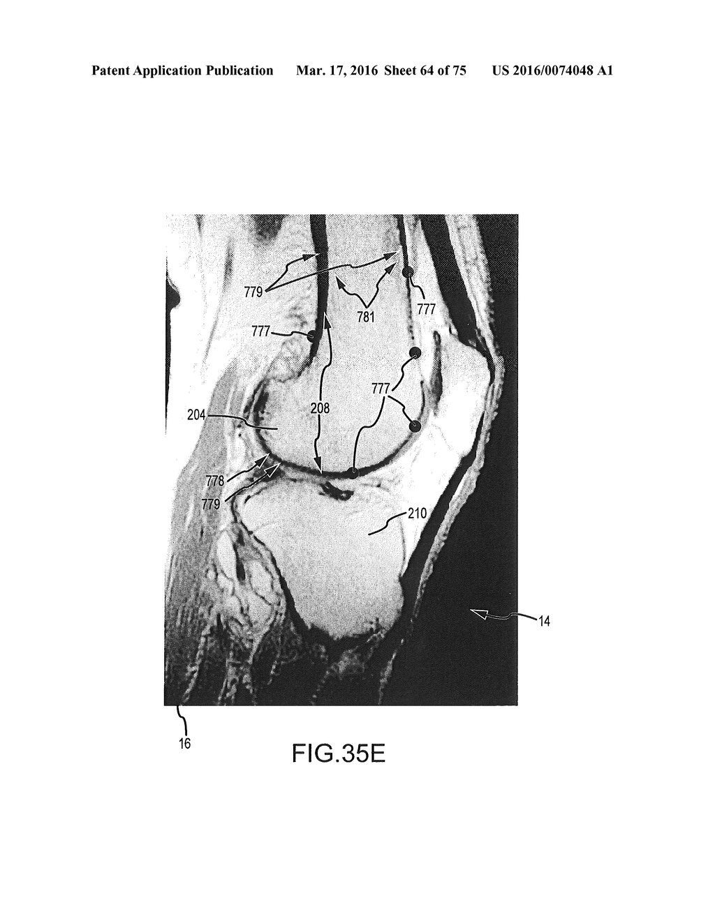 SYSTEM AND METHOD FOR IMAGE SEGMENTATION IN GENERATING COMPUTER MODELS OF     A JOINT TO UNDERGO ARTHROPLASTY - diagram, schematic, and image 65