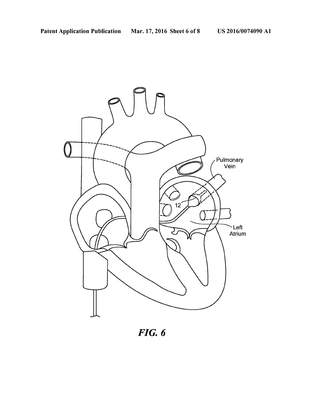 BALLOON DESIGN TO ENHANCE COOLING UNIFORMITY - diagram, schematic, and image 07