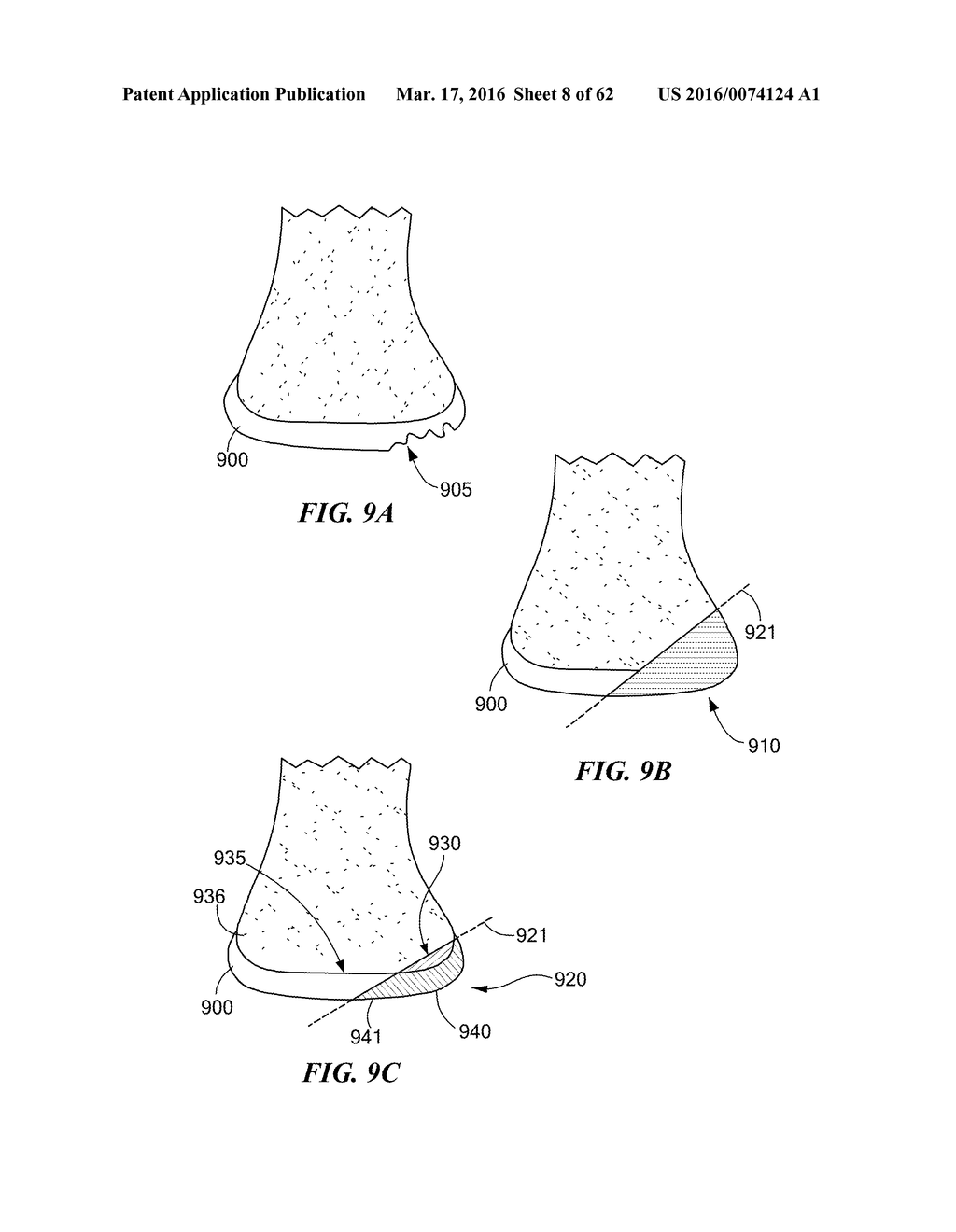 Patient Selectable Joint Arthroplasty Devices and Surgical Tools - diagram, schematic, and image 09