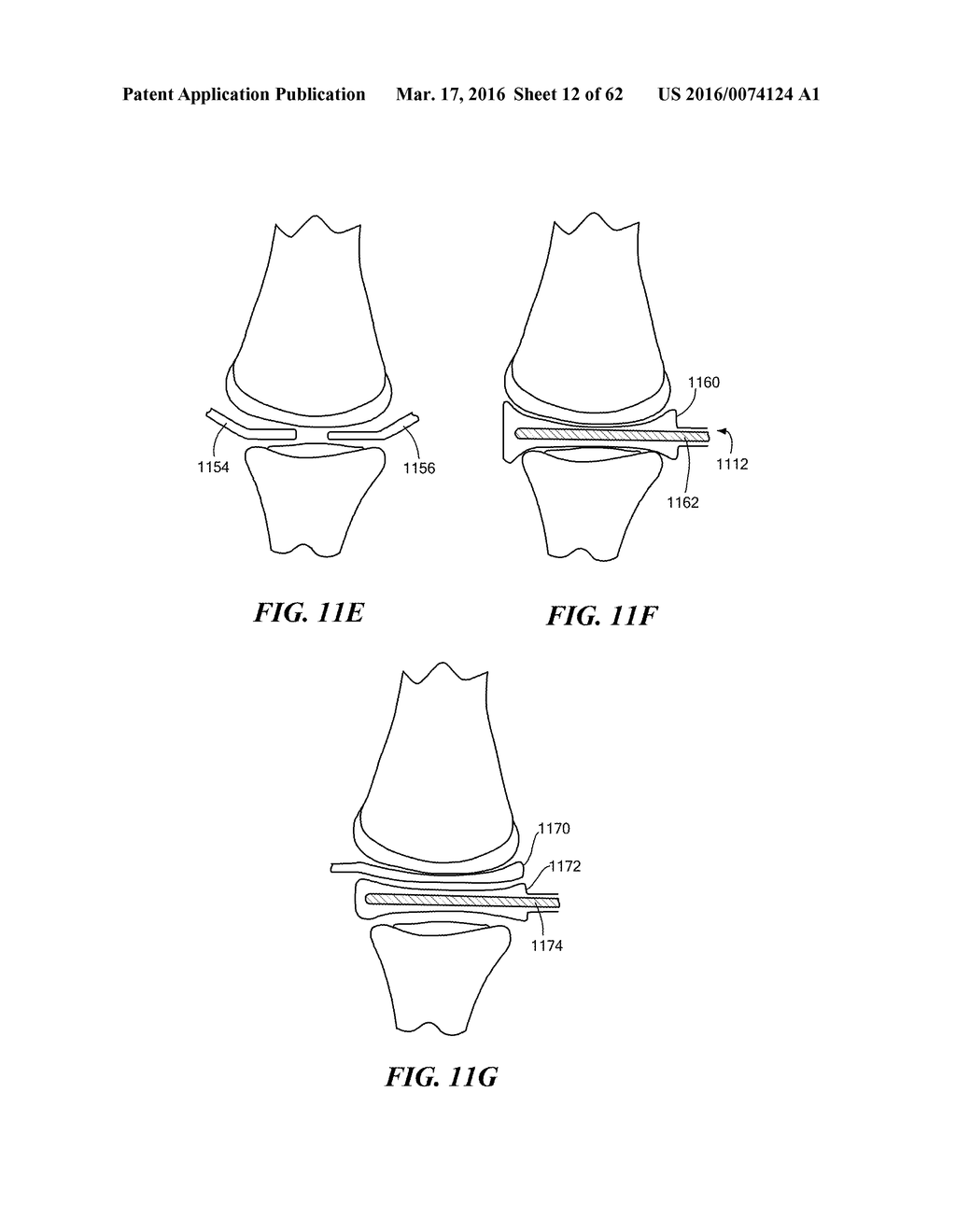 Patient Selectable Joint Arthroplasty Devices and Surgical Tools - diagram, schematic, and image 13