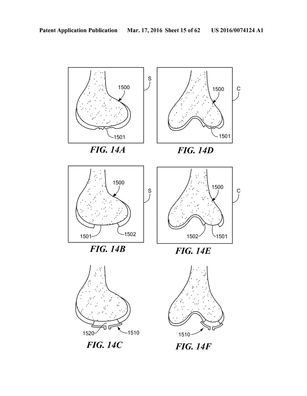 Patient Selectable Joint Arthroplasty Devices and Surgical Tools - diagram, schematic, and image 16