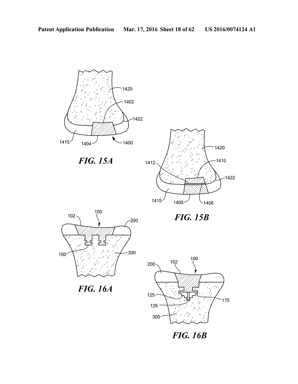 Patient Selectable Joint Arthroplasty Devices and Surgical Tools - diagram, schematic, and image 19