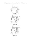 REINFORCED ALIGNER HOOKS diagram and image