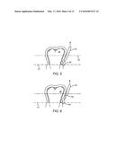 REINFORCED ALIGNER HOOKS diagram and image