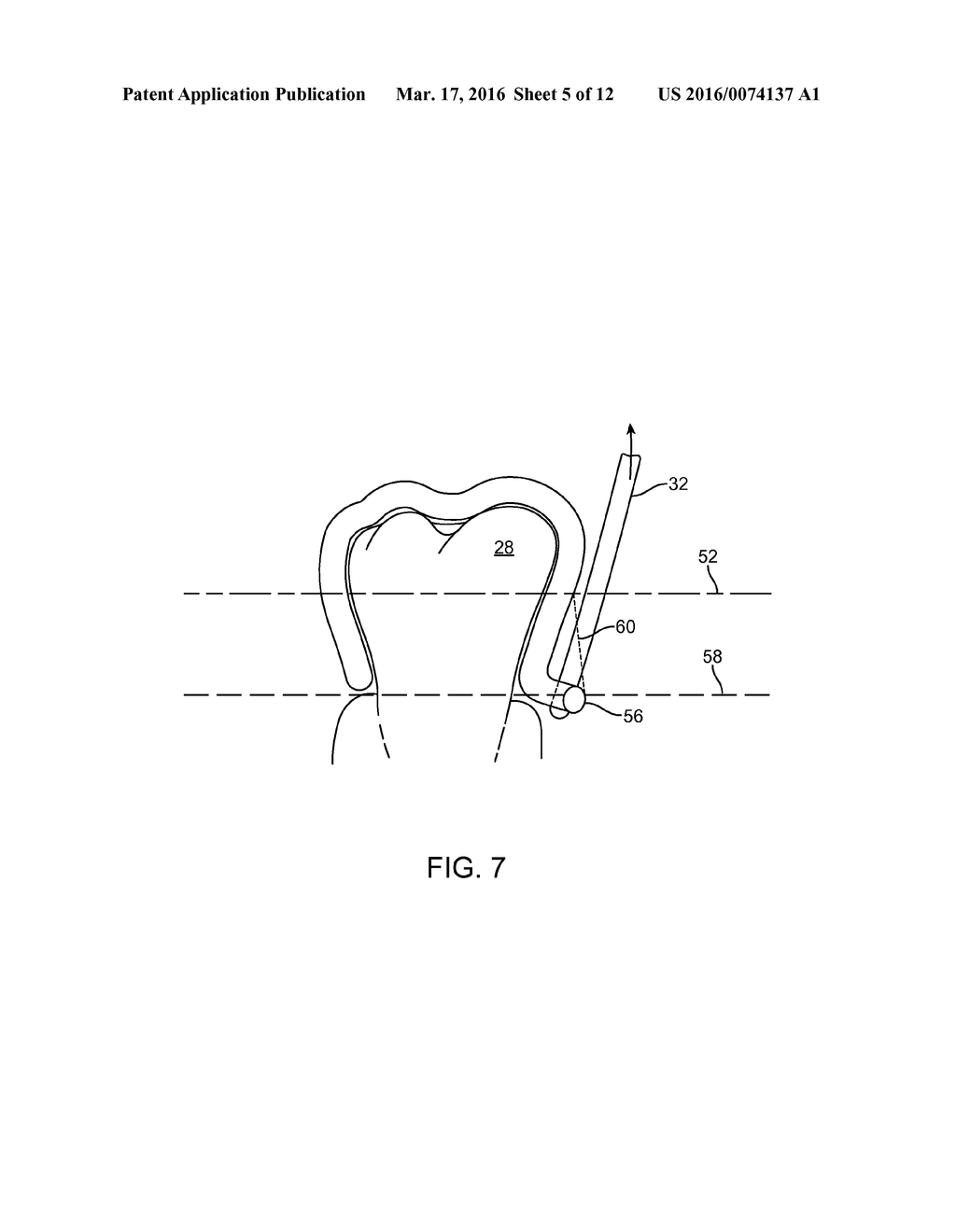 REINFORCED ALIGNER HOOKS - diagram, schematic, and image 06