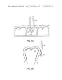 REINFORCED ALIGNER HOOKS diagram and image