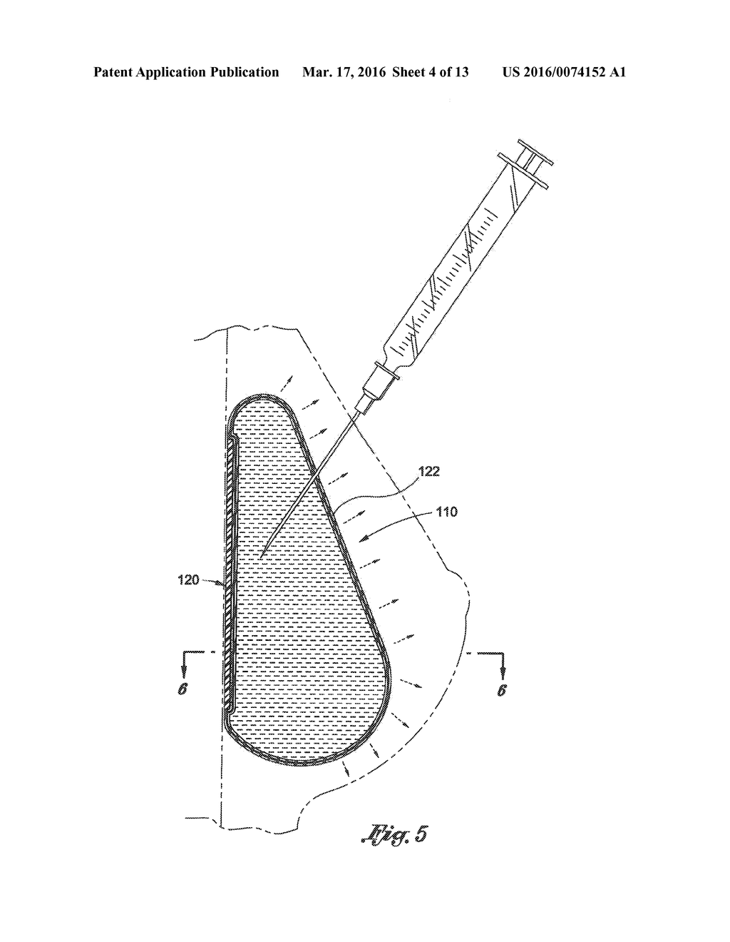 INFLATABLE PROSTHESES AND METHODS OF MAKING SAME - diagram, schematic, and image 05