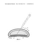 INFLATABLE PROSTHESES AND METHODS OF MAKING SAME diagram and image