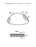 INFLATABLE PROSTHESES AND METHODS OF MAKING SAME diagram and image