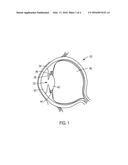 INTRAOCULAR LENS diagram and image