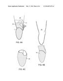 METHODS FOR PREPARING PRECISELY FITTED CASTS for PROSTHETICS diagram and image