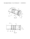 LOW PROFILE NON-SYMMETRICAL STENT diagram and image