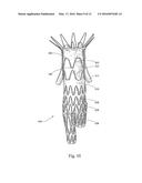 LOW PROFILE NON-SYMMETRICAL STENT diagram and image