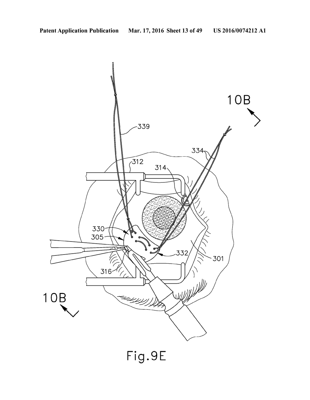 METHOD AND APPARATUS FOR SENSING POSITION BETWEEN LAYERS OF AN EYE - diagram, schematic, and image 14