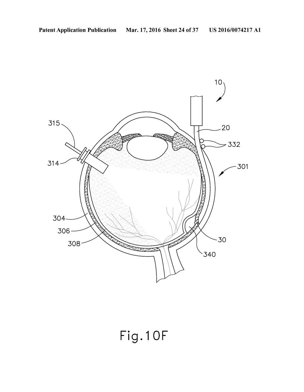 MOTORIZED SUPRACHOROIDAL INJECTION OF THERAPEUTIC AGENT - diagram, schematic, and image 25