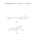 LASER APPARATUS AND METHOD FOR REFRACTIVE SURGERY diagram and image