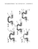 ABSORBENT ARTICLE COMPRISING A TOPSHEET/ACQUISITION LAYER LAMINATE diagram and image