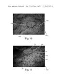 Nonwoven Material Having Discrete Three-Dimensional Deformations With Wide     Base Openings diagram and image