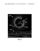 APPARATUS AND METHODS FOR IDENTIFYING AND EVALUATING BRIGHT SPOT     INDICATIONS OBSERVED THROUGH OPTICAL COHERENCE TOMOGRAPHY diagram and image