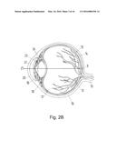 AN APPARATUS CONFIGURATED TO AND A PROCESS TO PHOTOACOUSTICALL IMAGE AND     MEASURE A STRUCTURE AT THE HUMAN EYE FUNDUS diagram and image