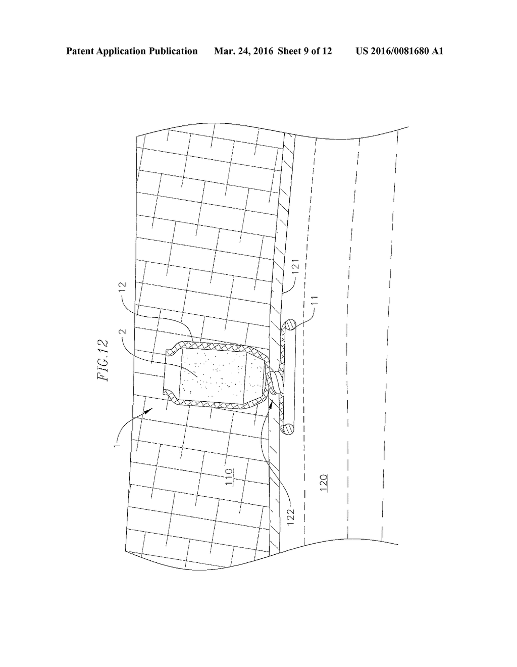 BIO-ABSORBABLE WOUND CLOSURE DEVICE AND METHOD - diagram, schematic, and image 10