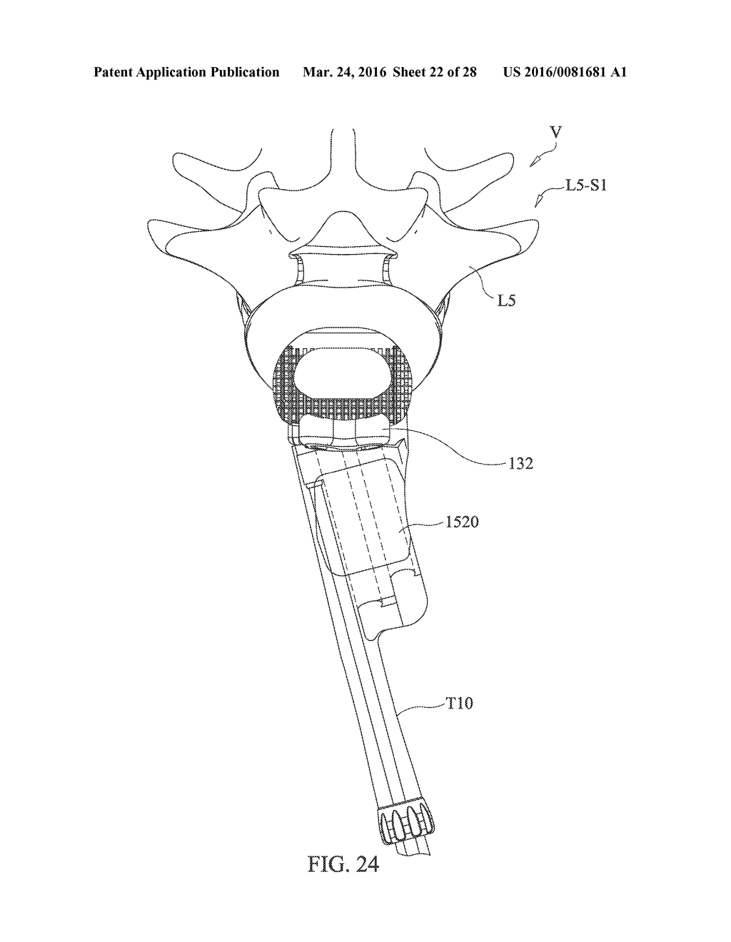 SPINAL IMPLANT SYSTEM AND METHOD FOR LUMBAR AND LUMBOSACRAL FUSION - diagram, schematic, and image 23