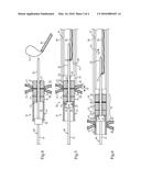 IMPLANTED MAGNETS RETRIEVAL SYSTEM AND METHOD diagram and image