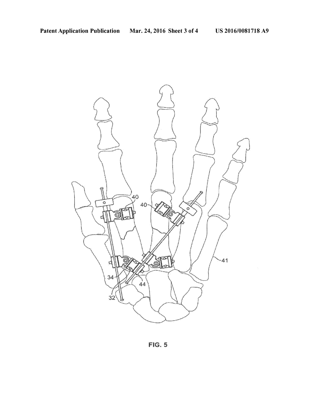 EXTERNAL FIXATOR - diagram, schematic, and image 04