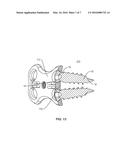 SURGICAL IMPLANT SYSTEM AND METHOD diagram and image