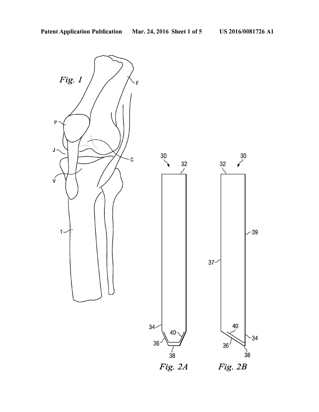 Percutaneous Fixator and Method of Insertion - diagram, schematic, and image 02