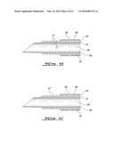 INTEGRATED CEMENT DELIVERY SYSTEM FOR BONE AUGMENTATION PROCEDURES AND     METHODS diagram and image