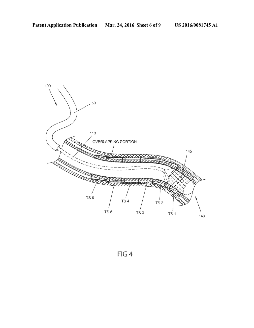 METHODS, SYSTEMS AND DEVICES FOR REDUCING THE LUMINAL SURFACE AREA OF THE     GASTROINTESTINAL TRACT - diagram, schematic, and image 07