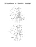 METHOD FOR PLACING IMPLANT USING ROBOTIC SYSTEM diagram and image