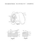 METHOD FOR PLACING IMPLANT USING ROBOTIC SYSTEM diagram and image