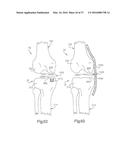 METHOD FOR PLACING IMPLANT USING ROBOTIC SYSTEM diagram and image