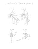 METHOD FOR PLACING IMPLANT USING ROBOTIC SYSTEM diagram and image