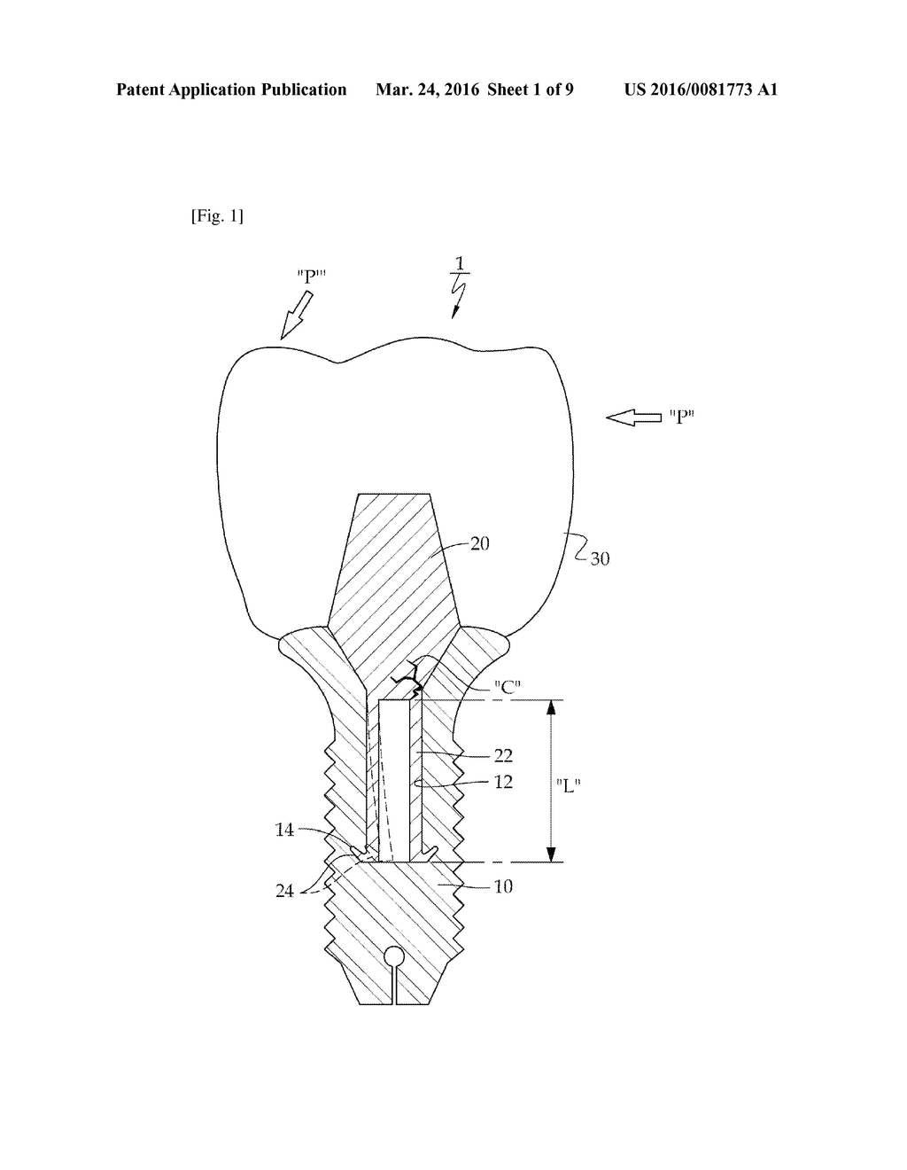 DENTAL IMPLANT - diagram, schematic, and image 02