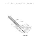 MEDICAL DEVICE, KIT AND METHOD FOR CONSTRICTING TISSUE OR A BODILY     ORIFICE, FOR EXAMPLE, A MITRAL VALVE diagram and image