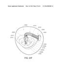 MEDICAL DEVICE, KIT AND METHOD FOR CONSTRICTING TISSUE OR A BODILY     ORIFICE, FOR EXAMPLE, A MITRAL VALVE diagram and image