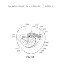 MEDICAL DEVICE, KIT AND METHOD FOR CONSTRICTING TISSUE OR A BODILY     ORIFICE, FOR EXAMPLE, A MITRAL VALVE diagram and image