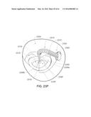 MEDICAL DEVICE, KIT AND METHOD FOR CONSTRICTING TISSUE OR A BODILY     ORIFICE, FOR EXAMPLE, A MITRAL VALVE diagram and image